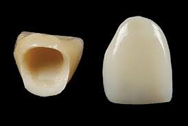 ceramic crown